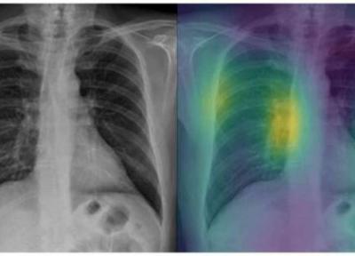 شناسایی سریع کووید-19 با یاری یک مدل مبتنی بر اشعه ایکس و هوش مصنوعی خبرنگاران