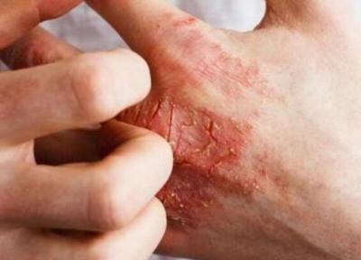 انواع حساسیت پوستی را بشناسید؛ از حساسیت به موبایل و رژ لب تا کهیر ، علائم بیماری های مرتبط با این حساسیت ها چیست؟